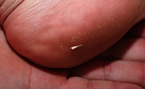 How to Remove Splinters Naturally - Gazette Review