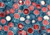 First Known U.S. Case of More Severe Mpox Strain Confirmed in California