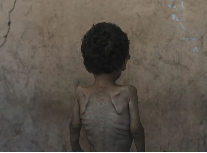 gaza starving children