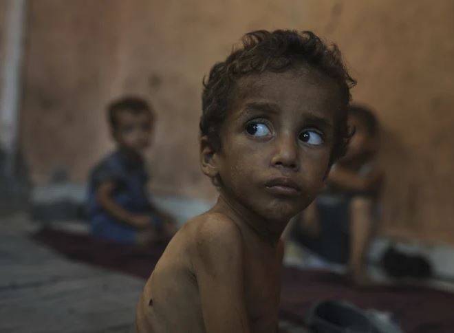 malnourished kids