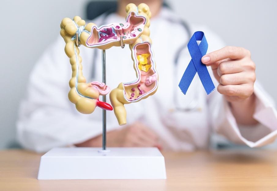 Colon Cancer Now the Leading Cause of Cancer Deaths Among Americans ...