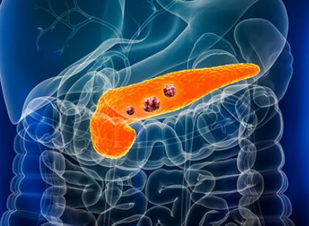 pancreatic cancer