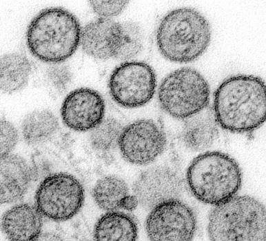 hantavirus
