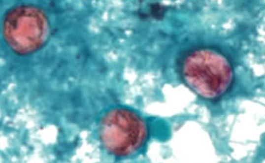 cyclospora-outbreak