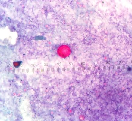 cyclosporiasis