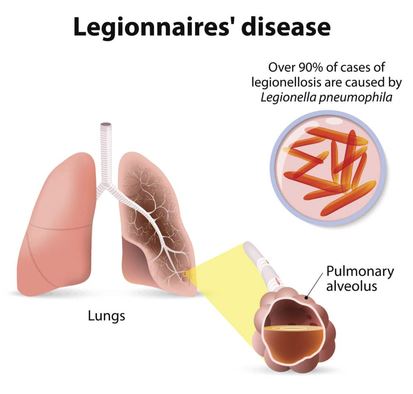 legionnaires disease